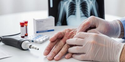 Rheumaarten Diagnose Behandlungen